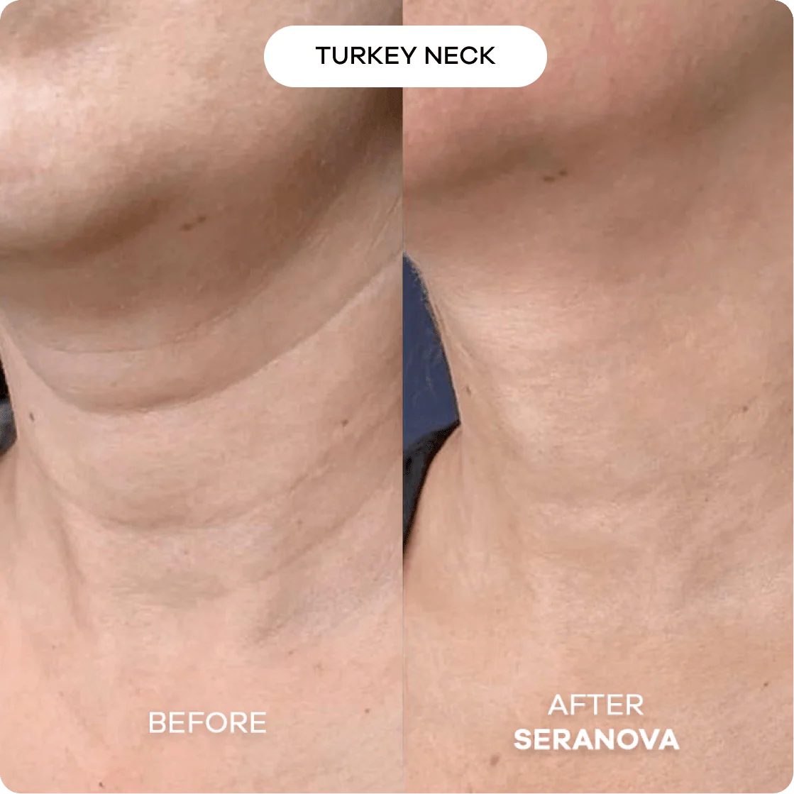 The Micro Infusion System