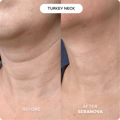 The Micro Infusion System